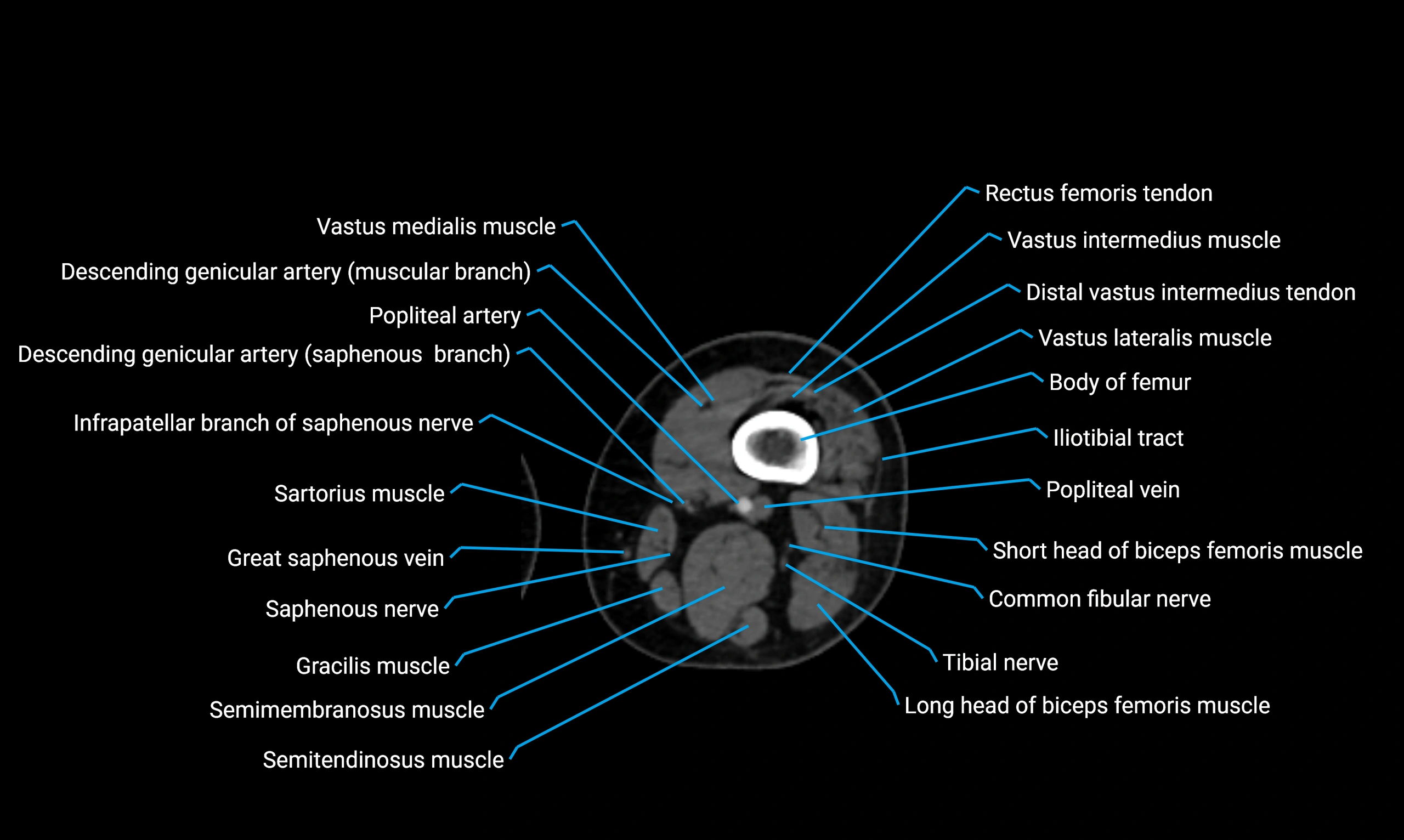 CT lower limb axial cross sectional anatomy labelled image 70 (2).webp
